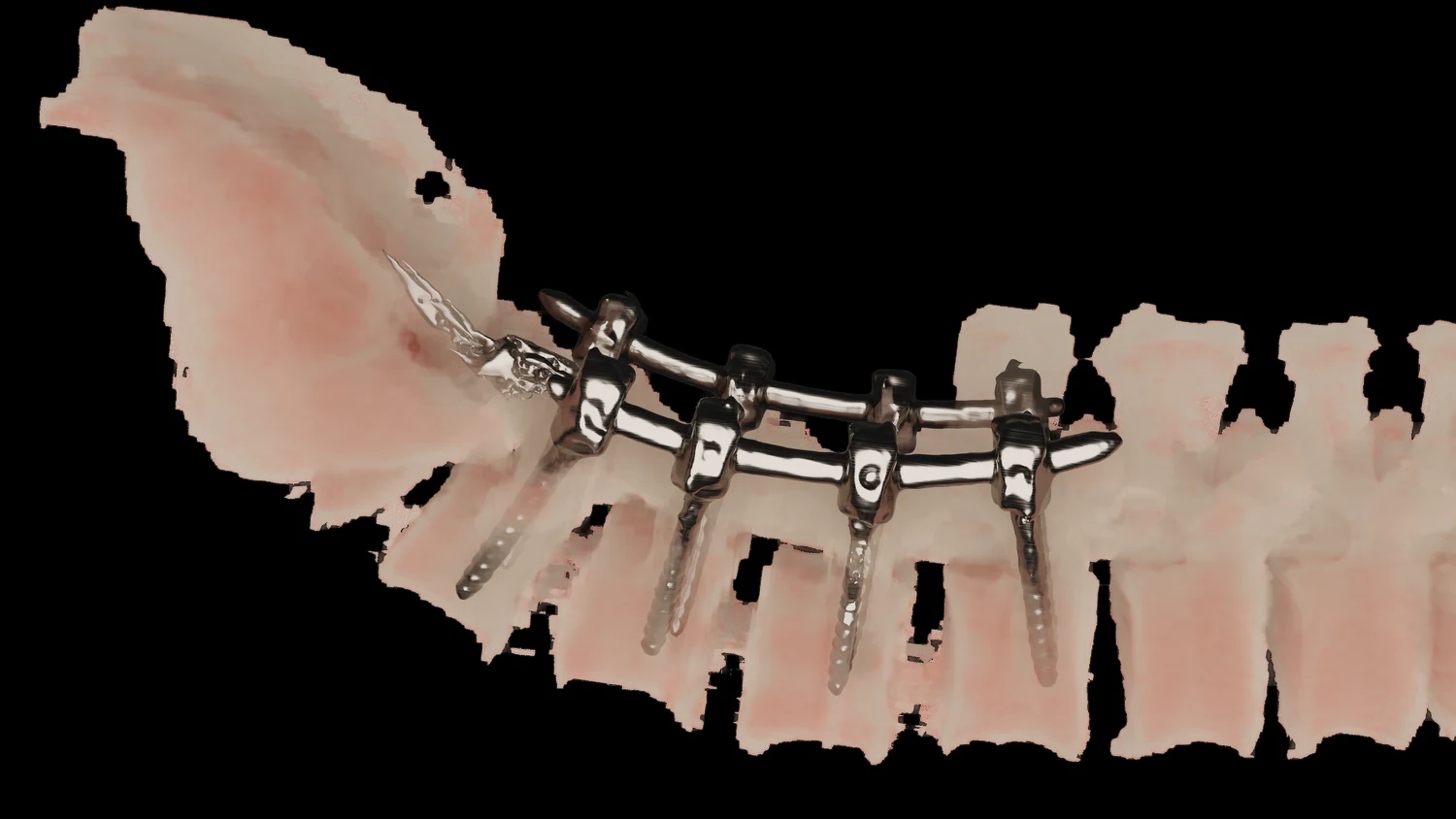 Spinal hardware 3D rendering